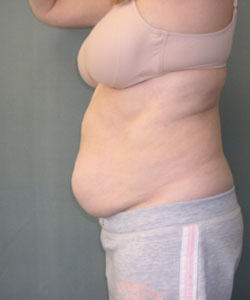 Abdominoplasty