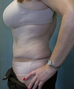 Abdominoplasty