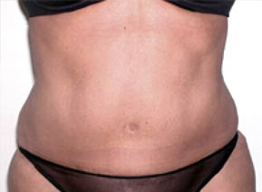 Abdominoplasty After Photo Abdominoplasty