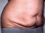 Abdominoplasty