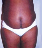 Abdominoplasty