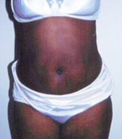 Abdominoplasty After Photo Abdominoplasty