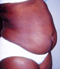 Abdominoplasty