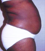 Abdominoplasty