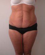 Abdominoplasty