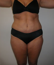 Abdominoplasty