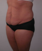 Abdominoplasty