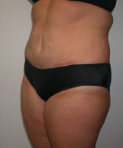 Abdominoplasty