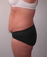 Abdominoplasty