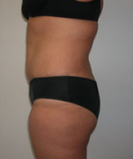 Abdominoplasty