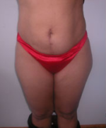 Abdominoplasty