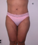 Abdominoplasty