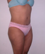 Abdominoplasty