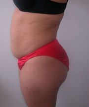 Abdominoplasty