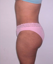 Abdominoplasty