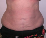 Abdominoplasty