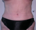 Abdominoplasty