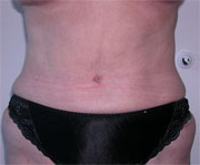 Abdominoplasty After Photo Abdominoplasty