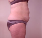 Abdominoplasty