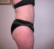 Abdominoplasty After Photo Abdominoplasty