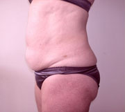 Abdominoplasty