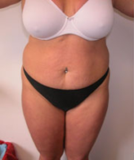 Abdominoplasty