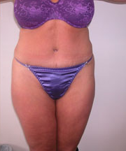 Abdominoplasty