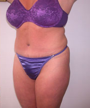 Abdominoplasty