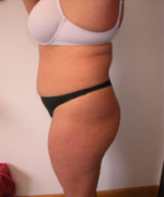 Abdominoplasty