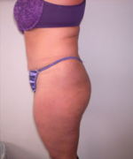 Abdominoplasty