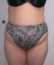 Abdominoplasty Before Photo Abdominoplasty