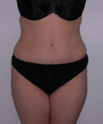 Abdominoplasty