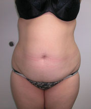 Abdominoplasty