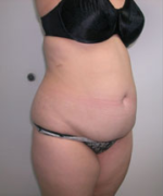 Abdominoplasty