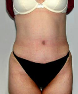 Abdominoplasty