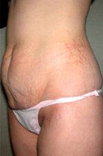 Abdominoplasty