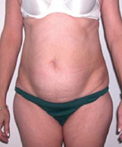 Abdominoplasty Before Photo Abdominoplasty