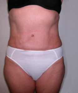 Abdominoplasty After Photo Abdominoplasty