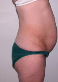 Abdominoplasty