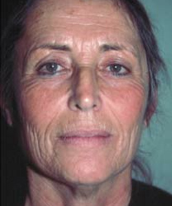 Biomedic Chemical Peel