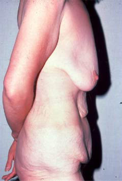 Body Lift Before Photo Body Lift