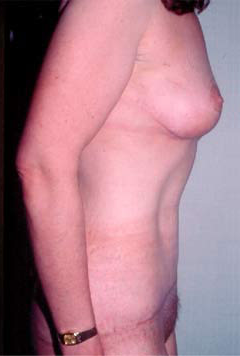 Body Lift After Photo Body Lift