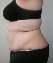 Body Lift Before Photo Body Lift