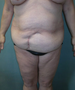 Body Lift Before Photo Body Lift