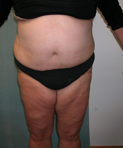 Body Lift After Photo Body Lift