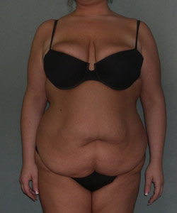 Body Lift Before Photo Body Lift