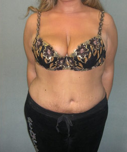 Body Lift After Photo Body Lift