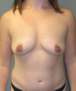 Breast Augmentation