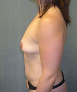 Breast Augmentation