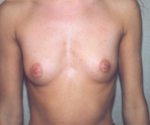 Breast Augmentation